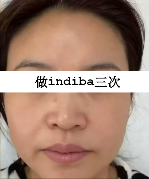 护理后