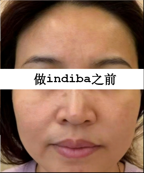 护理前