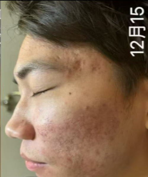 护理后