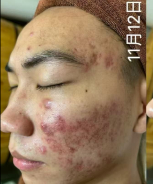 护理前